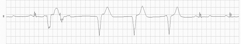 Ventricular Paced Beat LBB Morphology